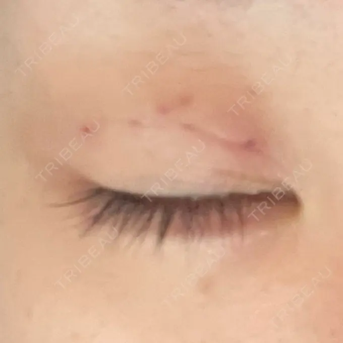 二重埋没 / ヒアルロン酸注入（涙袋） / ボトックス（エラ・小顔） / ヒアルロン酸注入（唇） / ボトックス（眉間） ネビュラクリニック 東京錦糸町院 DAY 22 メイン用