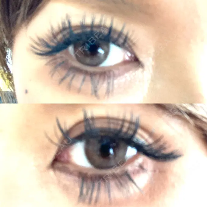 ヒアルロン酸注入（涙袋） / ヒアルロン酸注入（唇） アリエル美容クリニック 横浜院 DAY 6 メイン用