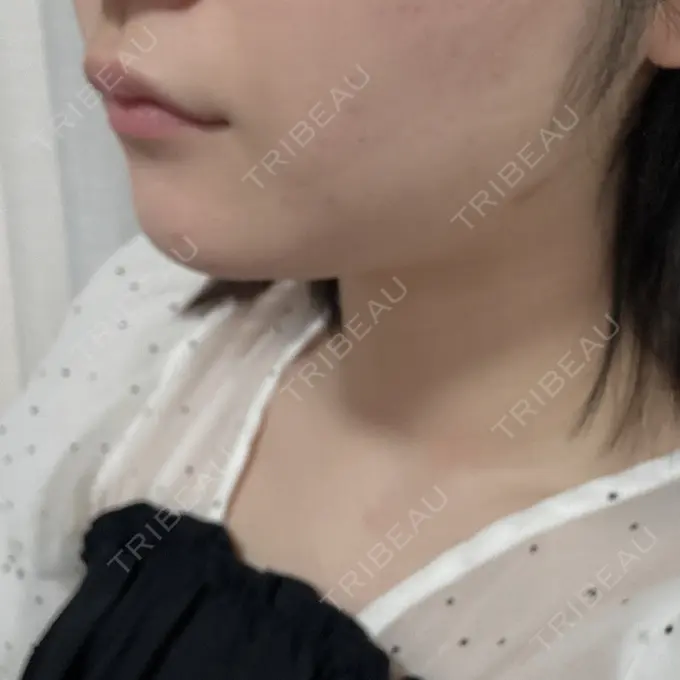 糸リフト / 脂肪吸引（顔） / 脂肪吸引注射（顔） ziz CLINIC AFTER メイン用