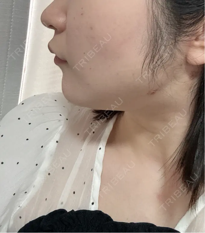 糸リフト / 脂肪吸引（顔） / 脂肪吸引注射（顔） ziz CLINIC DAY 0 メイン用