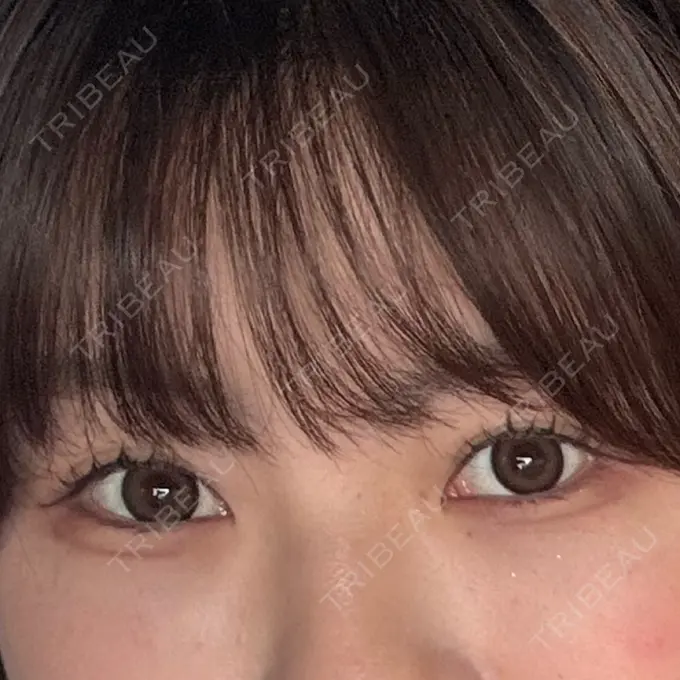 クマ治療 R Beauty CLINIC 銀座院 AFTER メイン用