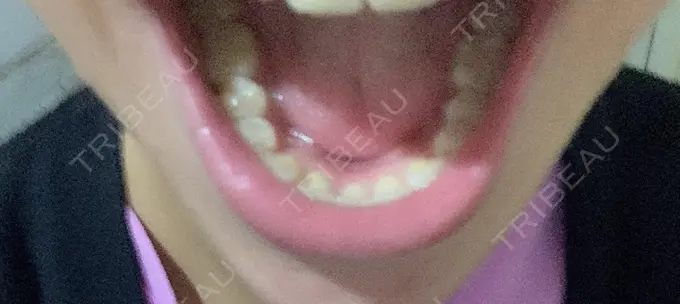 セラミック / その他（審美歯科/矯正歯科） 東京美容外科 赤坂院 AFTER メイン用