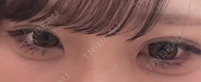 目尻切開 / タレ目形成・グラマラスライン（埋没） LOUIS CLINIC 二子玉川院【ルイクリニック】 AFTER メイン用