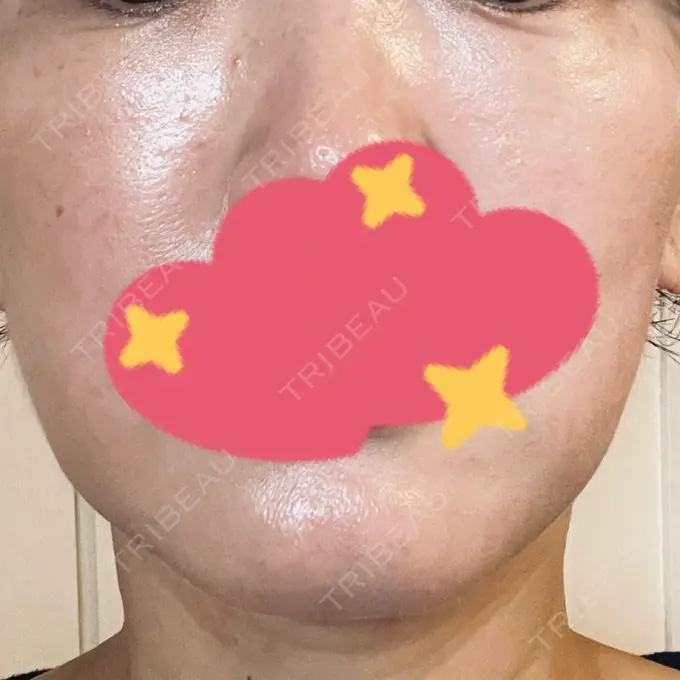 肌育注射（ジュベルックなど） B-LINE CLINIC 大阪院 AFTER メイン用