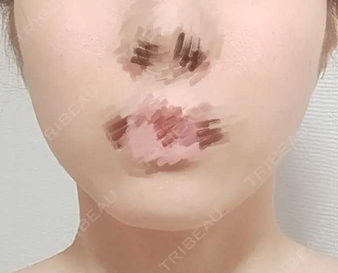 その他（輪郭） BITO BEAUTY CLINIC DAY 1 メイン用