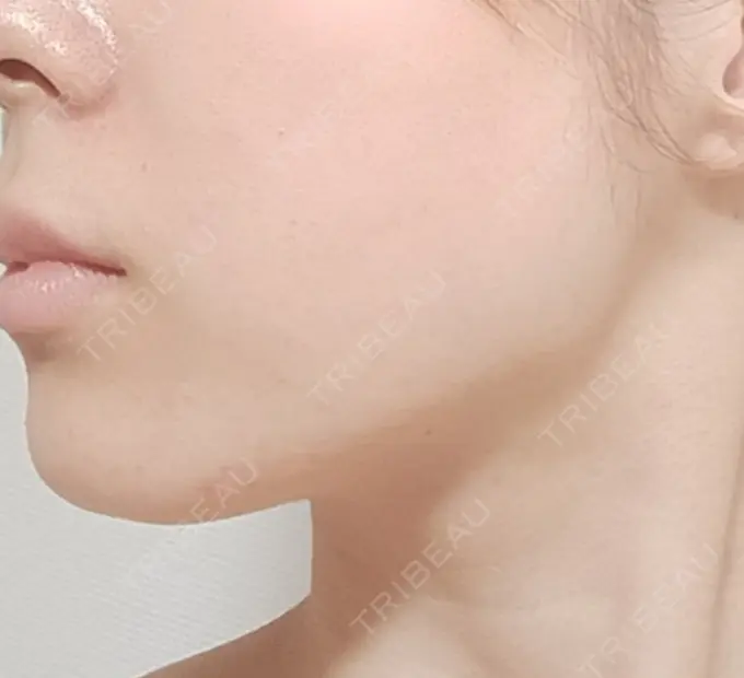 その他（輪郭） BITO BEAUTY CLINIC DAY 1 メイン用