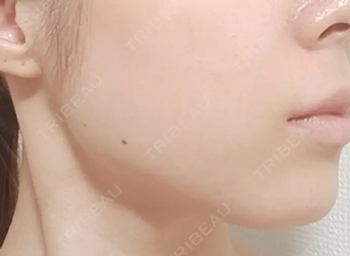 その他（輪郭） BITO BEAUTY CLINIC DAY 1 メイン用