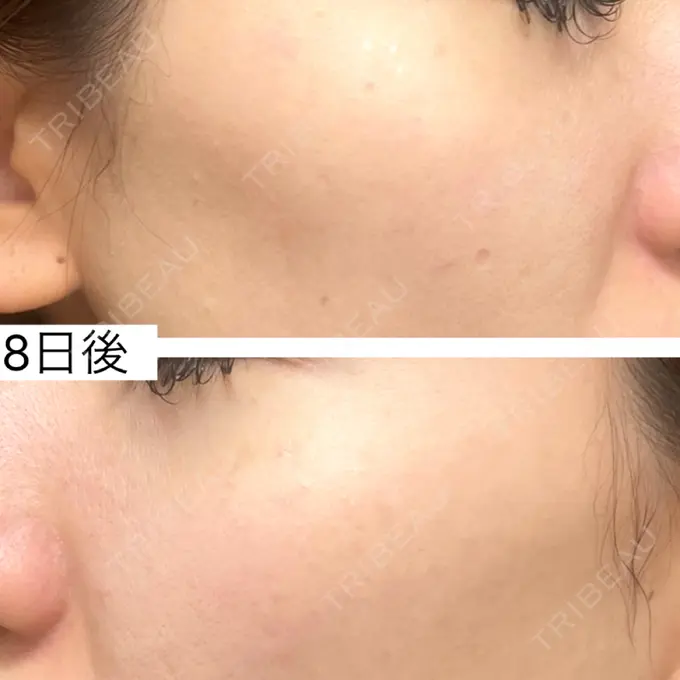 ピコスポット 博多もへじのクリニック DAY 8 メイン用