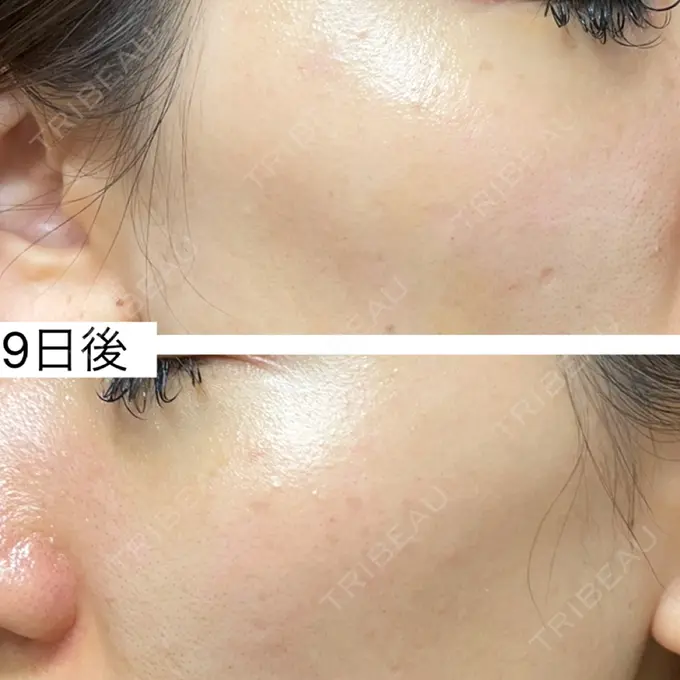 ピコスポット 博多もへじのクリニック DAY 9 メイン用