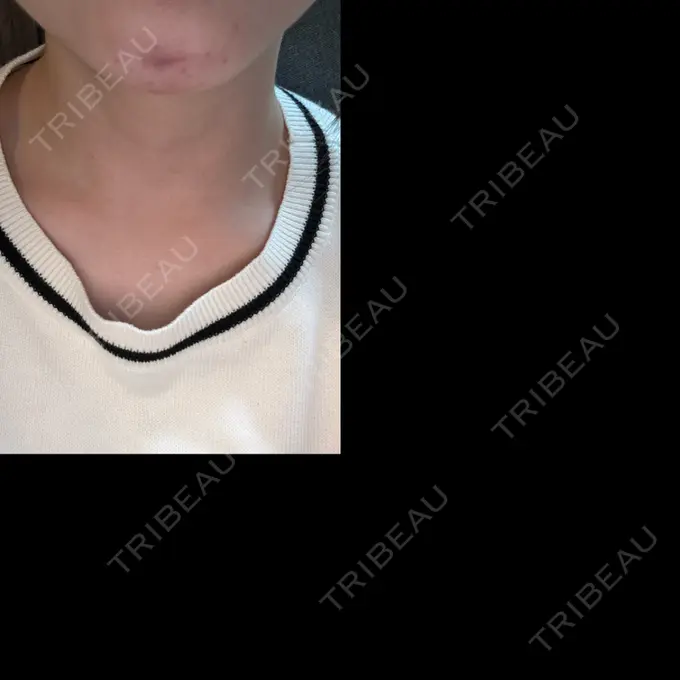 ヒアルロン酸注入（あご） TCB東京中央美容外科 大阪阪急梅田駅前院 DAY 0 メイン用