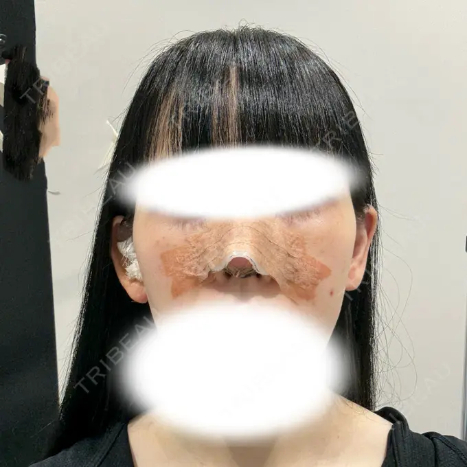 鼻尖形成（切開） / 鼻中隔延長（切開） / 軟骨移植 R Beauty CLINIC 名古屋院 DAY 4 メイン用