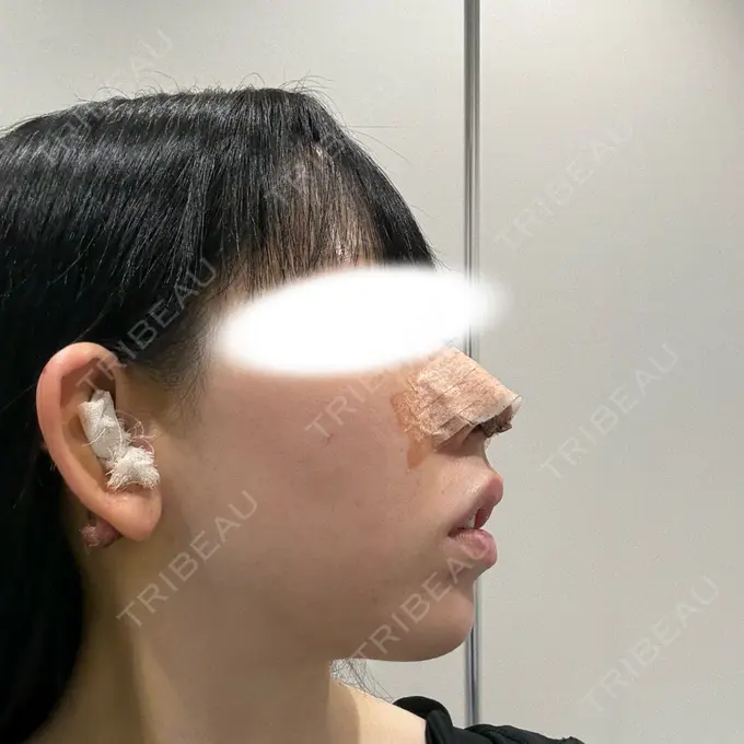 鼻尖形成（切開） / 鼻中隔延長（切開） / 軟骨移植 R Beauty CLINIC 名古屋院 DAY 4 メイン用