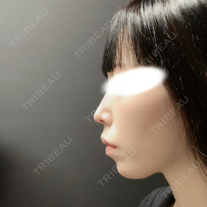 鼻尖形成（切開） / 鼻中隔延長（切開） / 軟骨移植 R Beauty CLINIC 名古屋院 AFTER メイン用