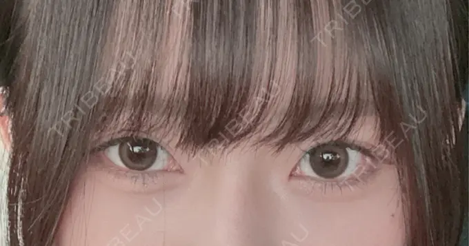 クマ治療 / ヒアルロン酸注入（目の下） eクリニック 名古屋院 AFTER メイン用