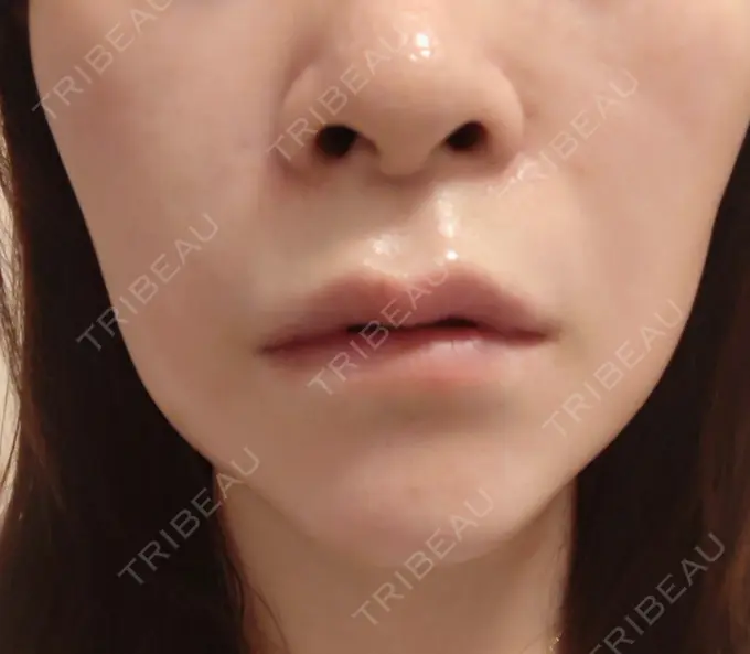 ボトックス（エラ・小顔） 新宿TAクリニック AFTER メイン用