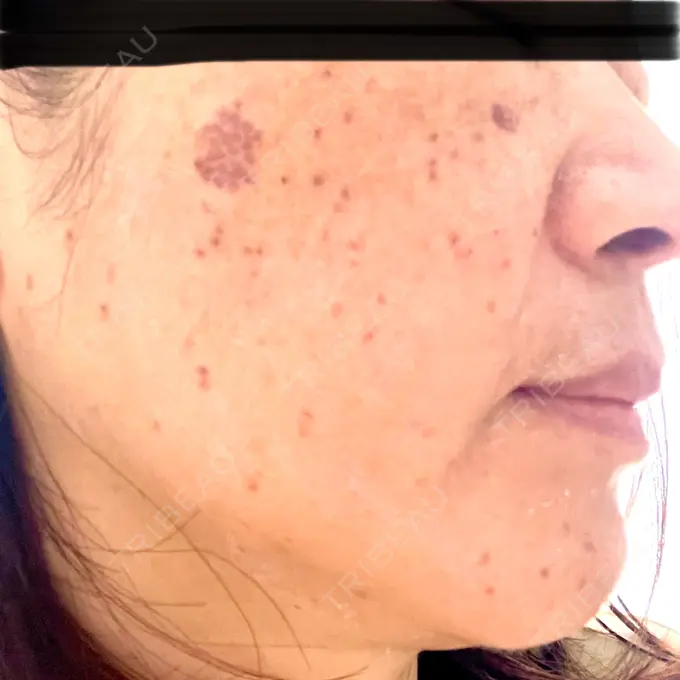 ピコレーザートーニング（美白・肝斑） / ピコスポット 東京シルククリニック 東京神田院 DAY 2 メイン用