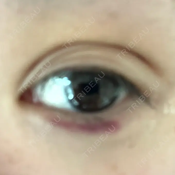 二重埋没 / ヒアルロン酸注入（涙袋） / ボトックス（エラ・小顔） / ヒアルロン酸注入（唇） / ボトックス（眉間） ネビュラクリニック 東京錦糸町院 DAY 23 メイン用