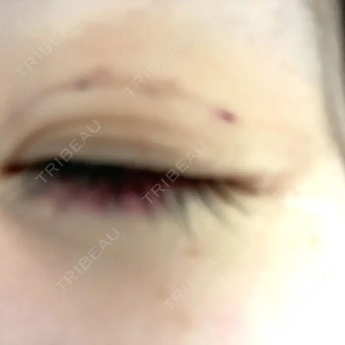 二重埋没 / ヒアルロン酸注入（涙袋） / ボトックス（エラ・小顔） / ヒアルロン酸注入（唇） / ボトックス（眉間） ネビュラクリニック 東京錦糸町院 DAY 23 メイン用