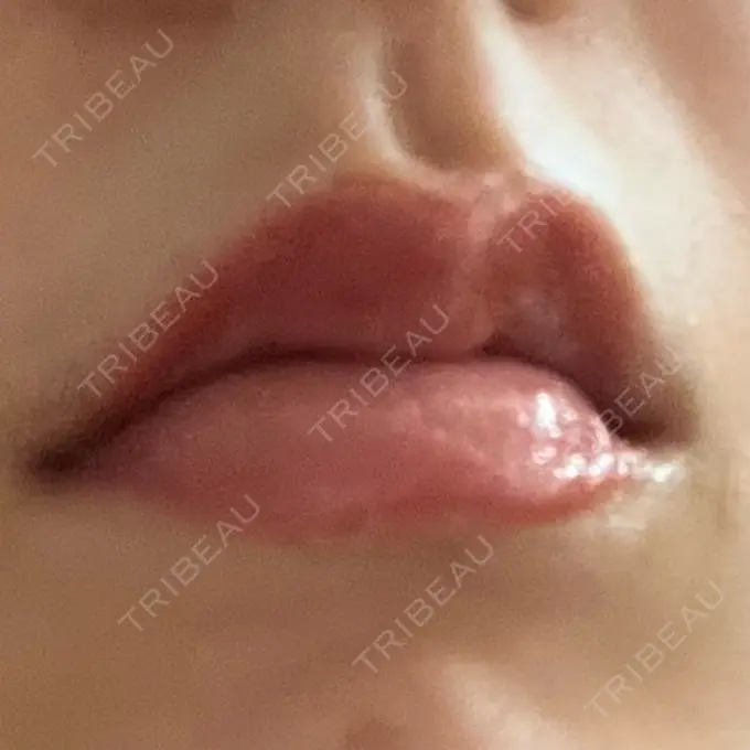 アートメイク（唇） Tokyo Tensei Clinic 新宿院 AFTER メイン用