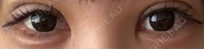 二重埋没 / 上まぶたの脂肪取り / ヒアルロン酸注入（涙袋） アリエル美容クリニック 横浜院 DAY 3 メイン用