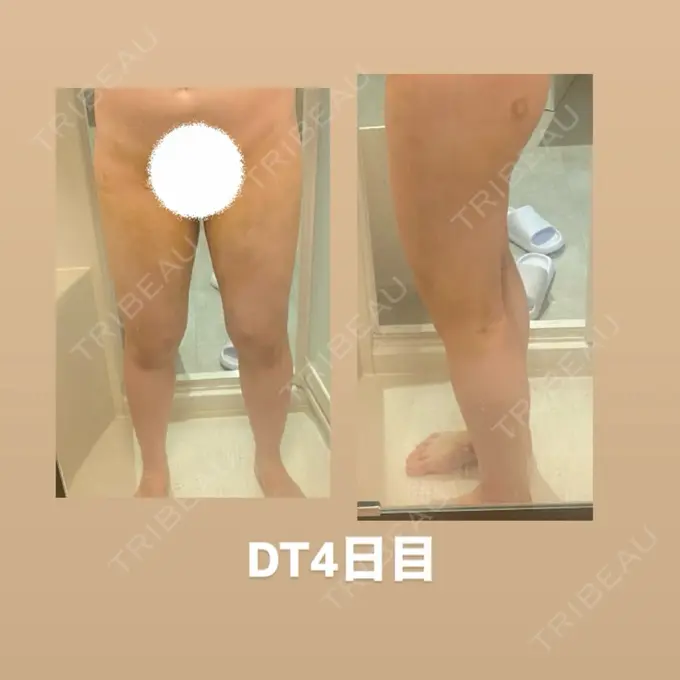 脂肪吸引（脚） 水の森美容クリニック 東京銀座院 DAY 4 メイン用