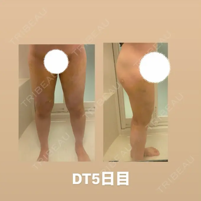 脂肪吸引（脚） 水の森美容クリニック 東京銀座院 DAY 5 メイン用