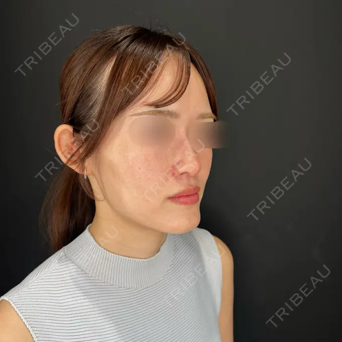 ヒアルロン酸注入（鼻） / ヒアルロン酸注入（鼻翼基部） HAAB×DREAM BEAUTY CLINIC 大阪梅田院 AFTER メイン用