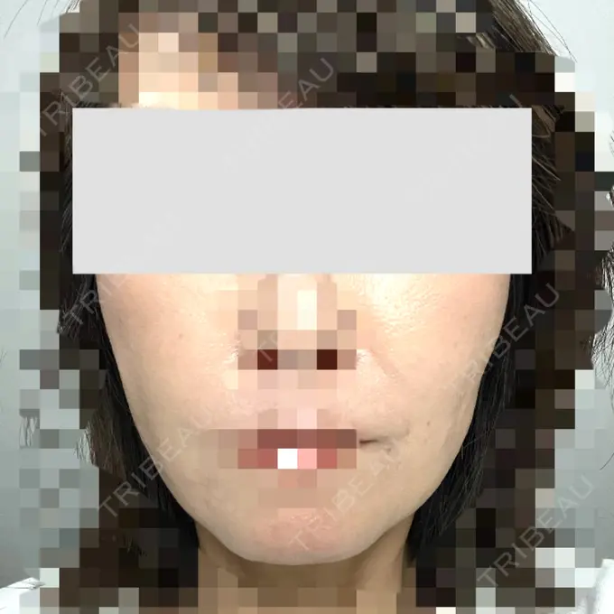 糸リフト / 肌ヒアルロン酸注入（たるみ・シワ改善） gift clinic DAY 34 メイン用