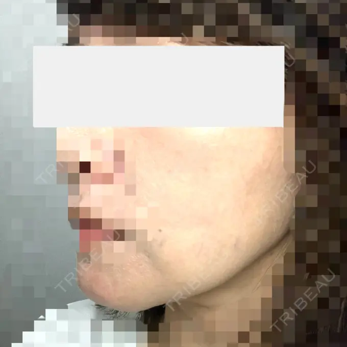 糸リフト / 肌ヒアルロン酸注入（たるみ・シワ改善） gift clinic DAY 34 メイン用