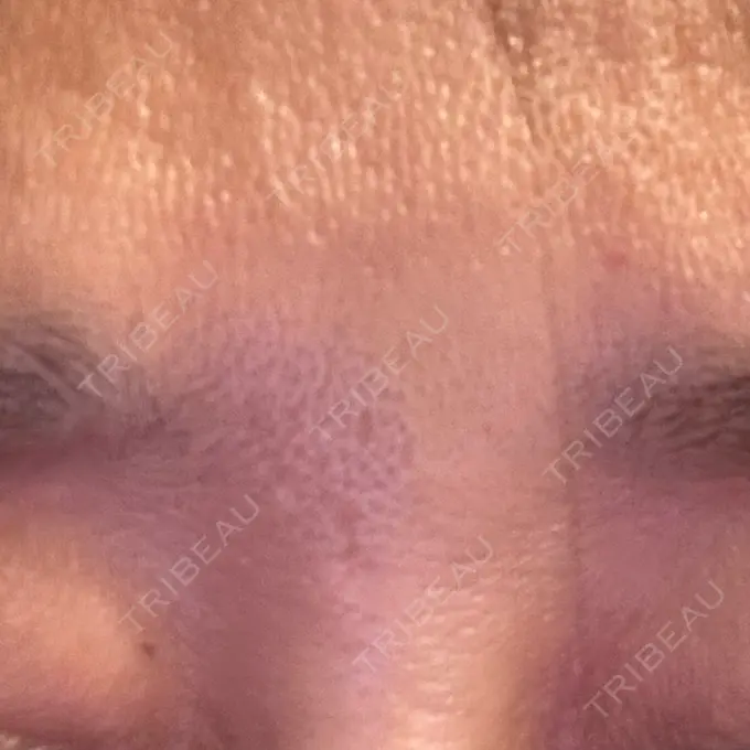 ボトックス（あご） / ボトックス（眉間） / ボトックス（額） / ボトックス（バニーライン） TCB東京中央美容外科 町田院 DAY 3 メイン用