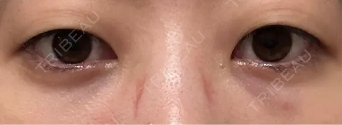 クマ治療 / 下まぶたたるみ取り / 下まぶたの脂肪取り / その他（目元） ROOTS Clinic DAY 0 メイン用