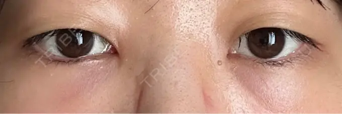 クマ治療 / 下まぶたたるみ取り / 下まぶたの脂肪取り / その他（目元） ROOTS Clinic DAY 1 メイン用