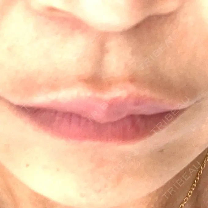 ヒアルロン酸注入（涙袋） / ヒアルロン酸注入（唇） アリエル美容クリニック 横浜院 AFTER メイン用