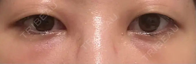 クマ治療 / 下まぶたたるみ取り / 下まぶたの脂肪取り / その他（目元） ROOTS Clinic DAY 2 メイン用