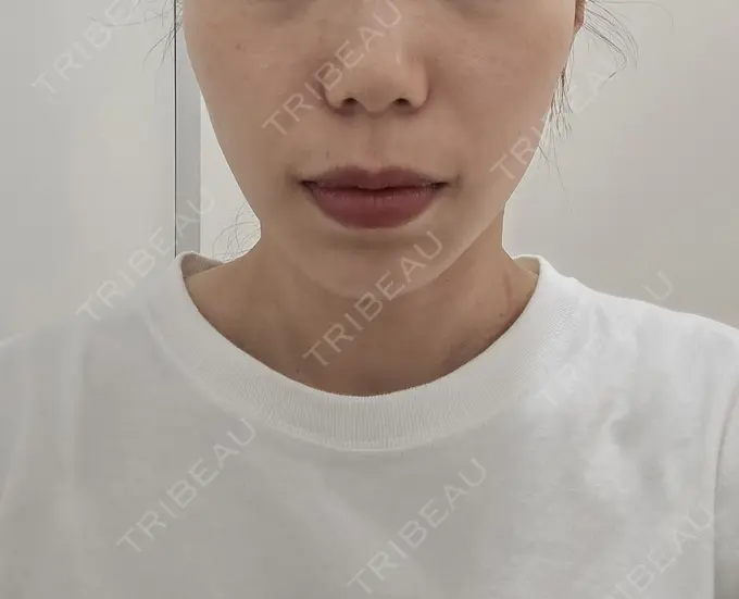 ハイフ（顔） 東京美容外科 福岡院 DAY 0 メイン用