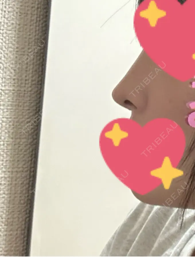 軟骨移植 吉祥寺アイビークリニック AFTER メイン用