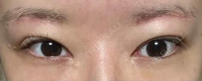 下まぶたの脂肪取り / 眉下切開 東京中央クリニック DAY 32 メイン用