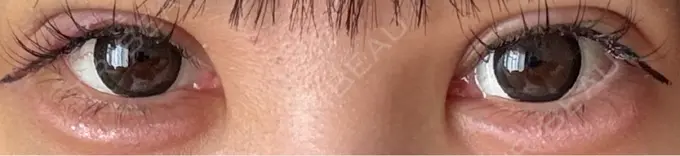 二重埋没 / 上まぶたの脂肪取り / ヒアルロン酸注入（涙袋） アリエル美容クリニック 横浜院 DAY 4 メイン用