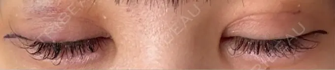 二重埋没 / 上まぶたの脂肪取り / ヒアルロン酸注入（涙袋） アリエル美容クリニック 横浜院 DAY 4 メイン用