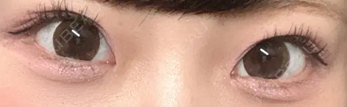 クマ治療 / 脂肪注入（目の下） R Beauty CLINIC 銀座院 DAY 2 メイン用