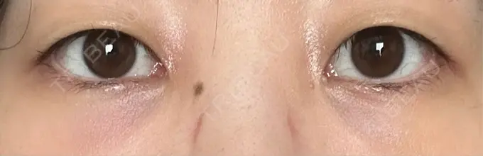 クマ治療 / 下まぶたたるみ取り / 下まぶたの脂肪取り / その他（目元） ROOTS Clinic DAY 3 メイン用