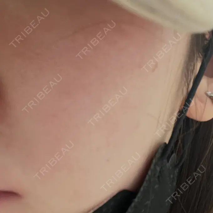 イオン導入 / ピーリング（ハリ・ツヤ） / ルメッカ ルラ美容クリニック 仙台院 / ルラスキンクリニック 仙台院 AFTER メイン用