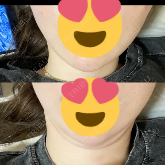 糸リフト / 脂肪吸引（顔） ヴェルトラクリニック 新宿院 AFTER メイン用