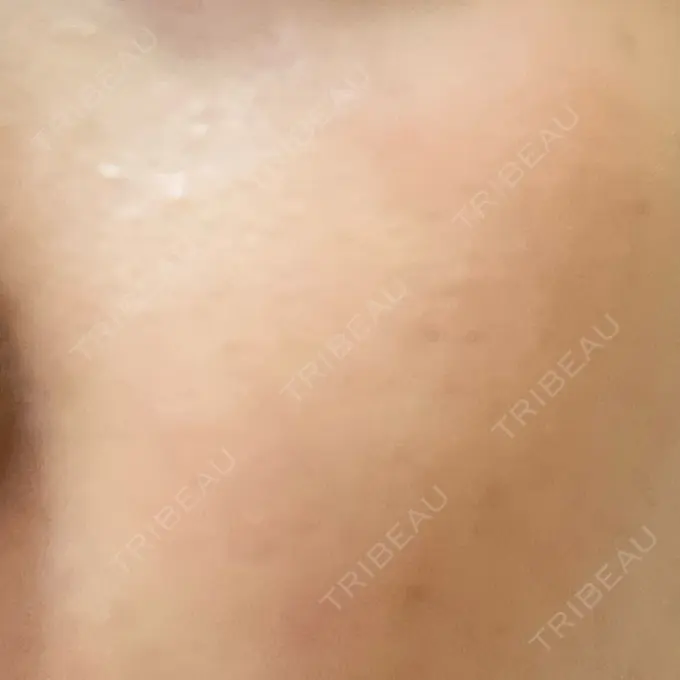 ピーリング（ニキビ・毛穴） 大美会クリニック 岡山院 AFTER メイン用