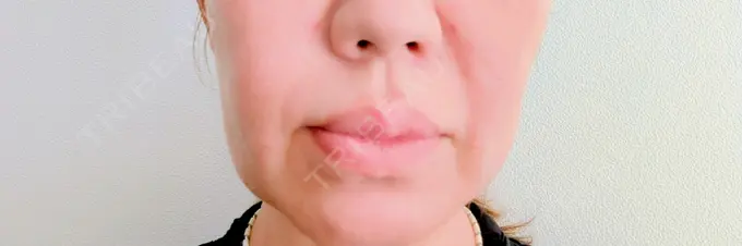 糸リフト アリエル美容クリニック 横浜院 DAY 1 メイン用