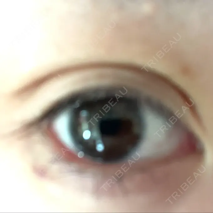 二重埋没 / ヒアルロン酸注入（涙袋） / ボトックス（エラ・小顔） / ヒアルロン酸注入（唇） / ボトックス（眉間） ネビュラクリニック 東京錦糸町院 DAY 25 メイン用