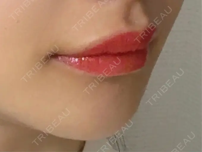 アートメイク（唇） 筋肉・美容クリニック DAY 0 メイン用
