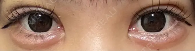 二重埋没 / 上まぶたの脂肪取り / ヒアルロン酸注入（涙袋） アリエル美容クリニック 横浜院 DAY 5 メイン用