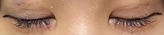 二重埋没 / 上まぶたの脂肪取り / ヒアルロン酸注入（涙袋） アリエル美容クリニック 横浜院 DAY 5 メイン用