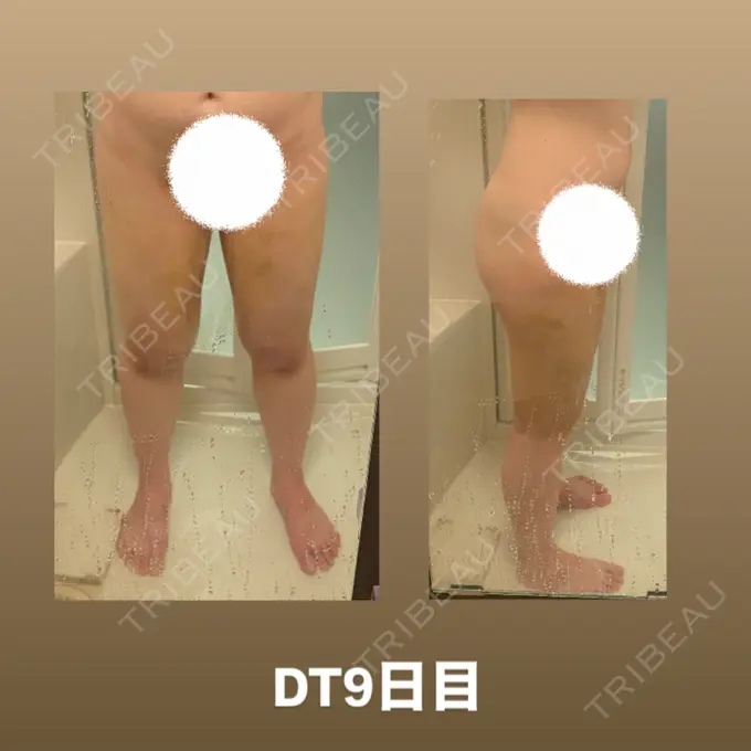 脂肪吸引（脚） 水の森美容クリニック 東京銀座院 DAY 9 メイン用